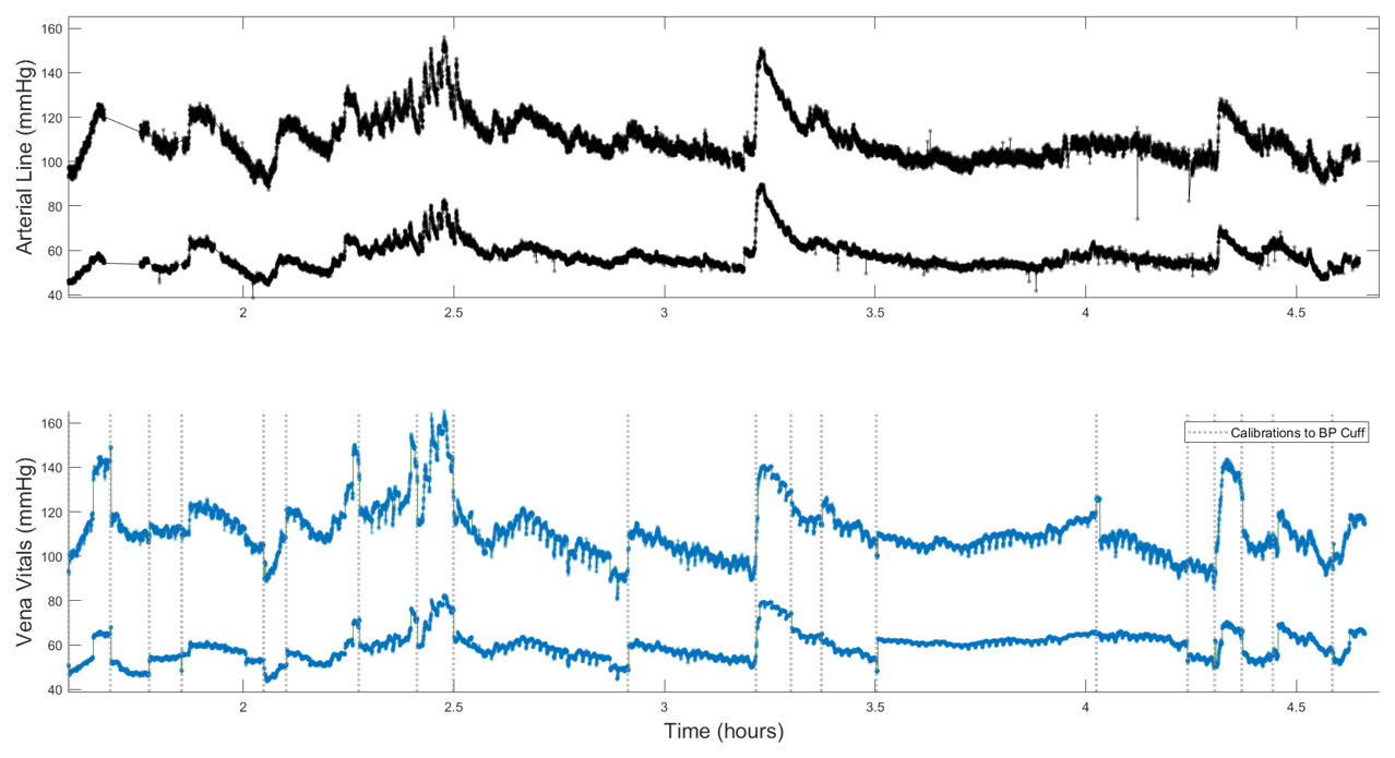 Arterial line and Vena Vitals pressure traces plotted one above the other for a craniotomy case