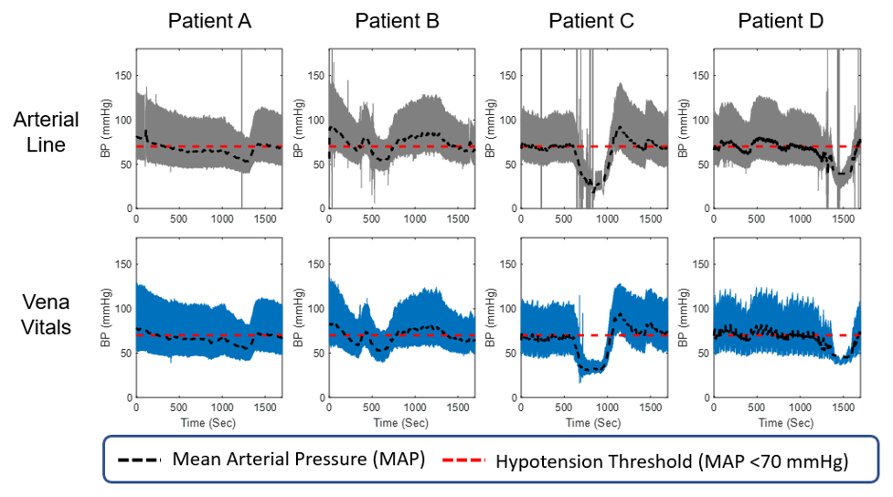 A steep fall and recovery in blood pressure, tracked by both the arterial line and the sensor-derived signal
